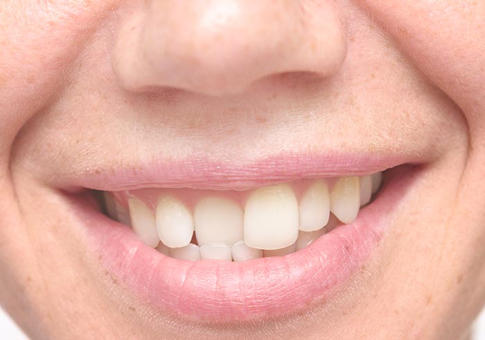 Crooked and Misaligned Teeth Treatment at Graceful Dental