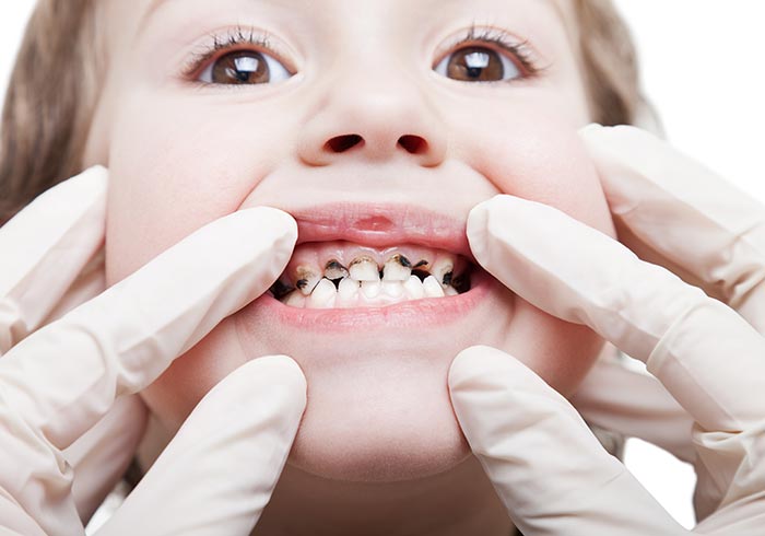 Tooth Decay Treatment Surrey Hills